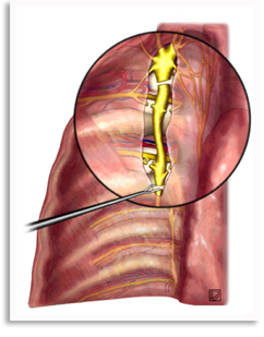 hyperhidrosis surgery