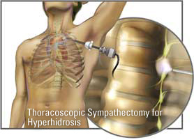 Hyperhidrosis Surgery ETS