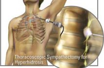 hyperhidrosis surgery