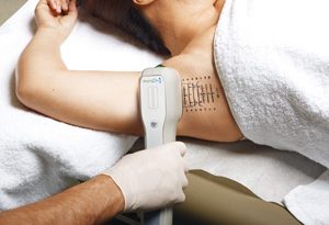 miraDry for Hyperhidrosis miradry works by destroying sweat glands in underarm area